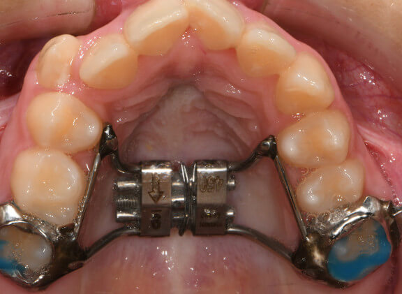 palatal expander